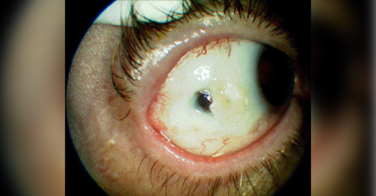 Spot The Diagnosis Of Given Ophthalmic Condition
