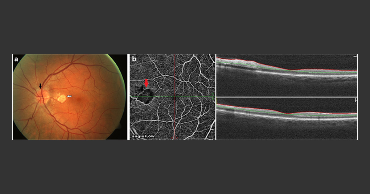 Loss Of Vision After Dental Treatment