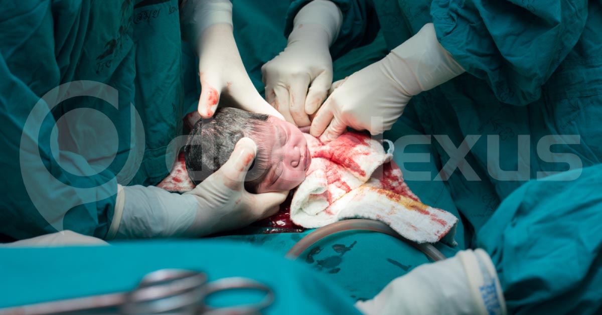 Induced Labor At 39 Weeks May Reduce Likelihood Of C-section