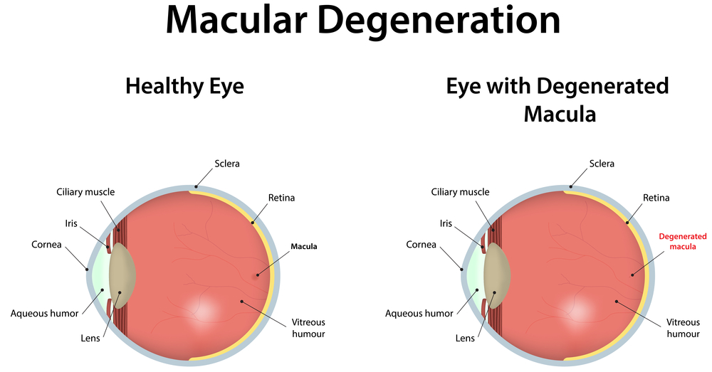 Stages Of Vitelliform Macular Degeneration