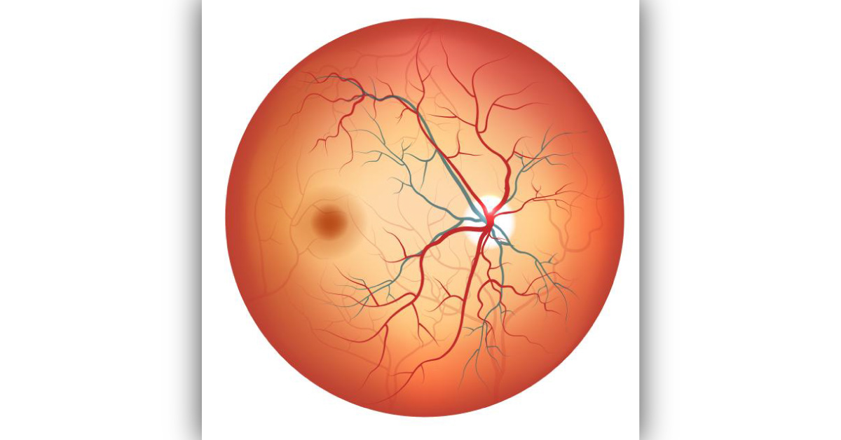 Congenital Anomalies Of The Disc