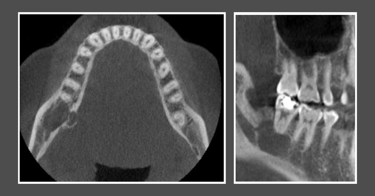 Diagnose This Case Of Mandibular Swelling