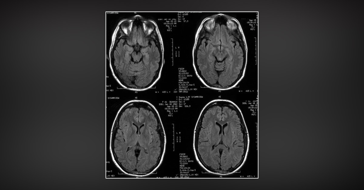 When a Headache is Not Just a Headache