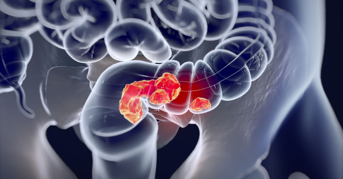 Intracorporeal Vs Extracorporeal Anastomosis: What’s the Preferred Choice?