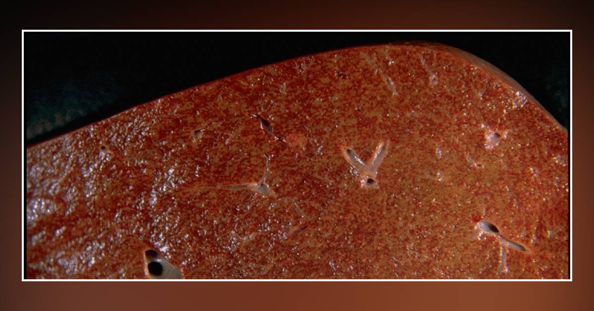 What is the Most Likely Reason for This Patient’s Death?