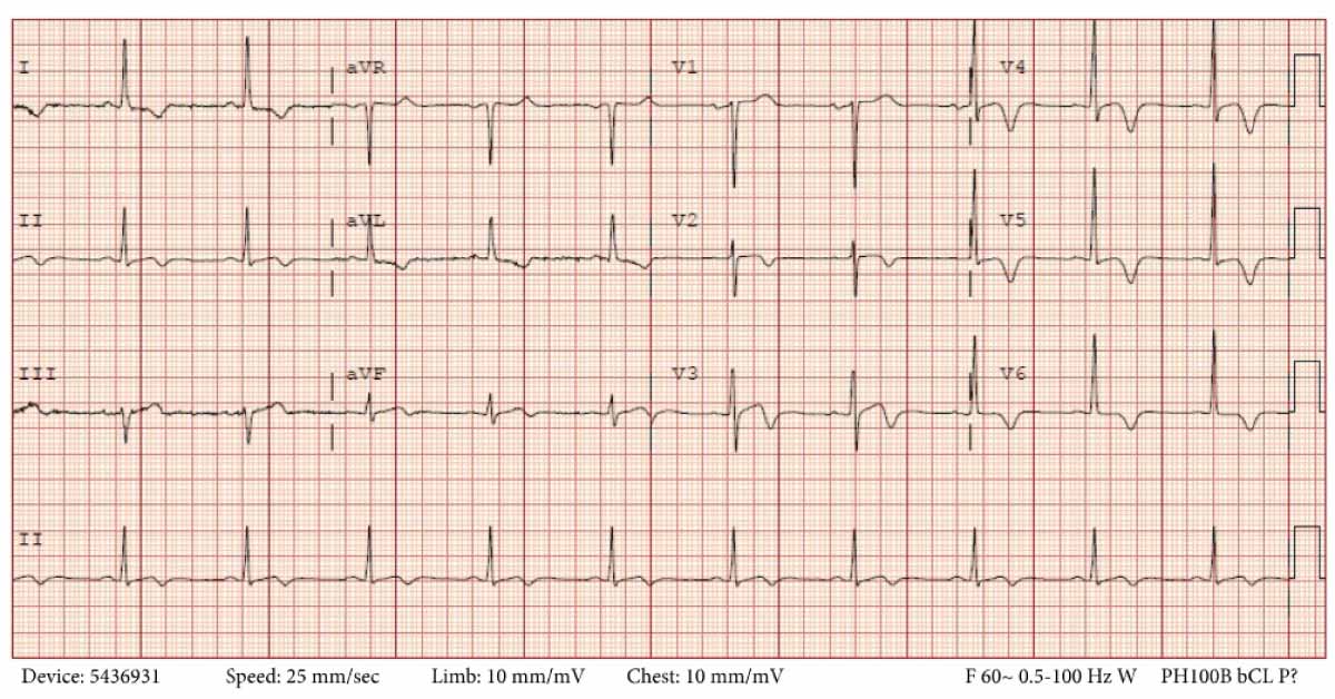 Man with Multiple Episodes of Chest Pain - What's Your Diagnosis?