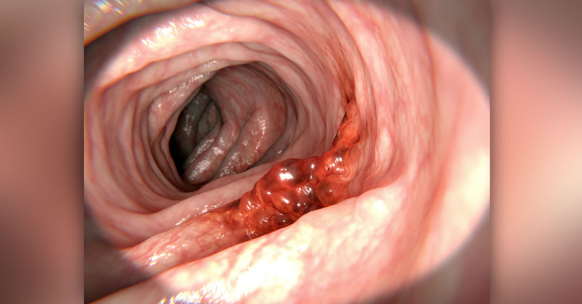 Regular Fecal Occult-Blood Tests reduce the burden of colorectal cancer?