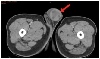 Enlarged Testis: Can You Diagnose This Elderly Man's Condition?