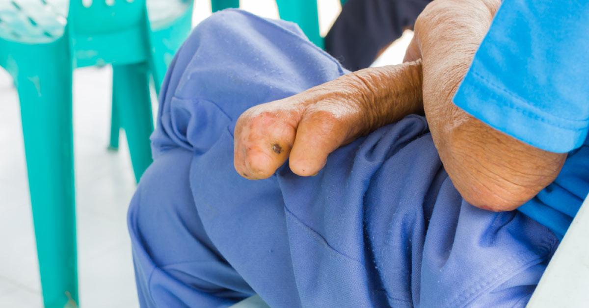 Are Immunomodulators Needed in Managing Leprosy?