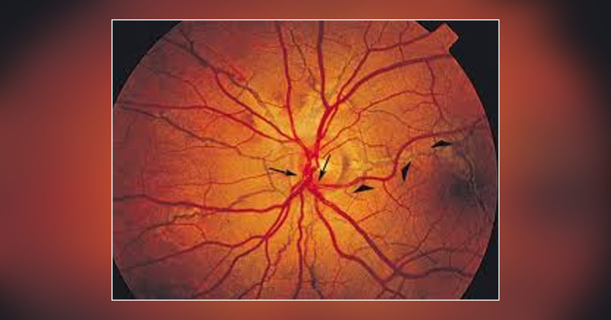 Review On The Causes Of Angioid Streaks