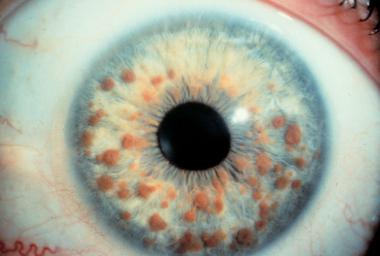 Diagnose The Eye Condition