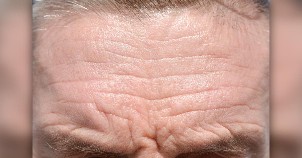Prominent Wrinkles On Forehead May Predict Cardiovascular Death Risk
