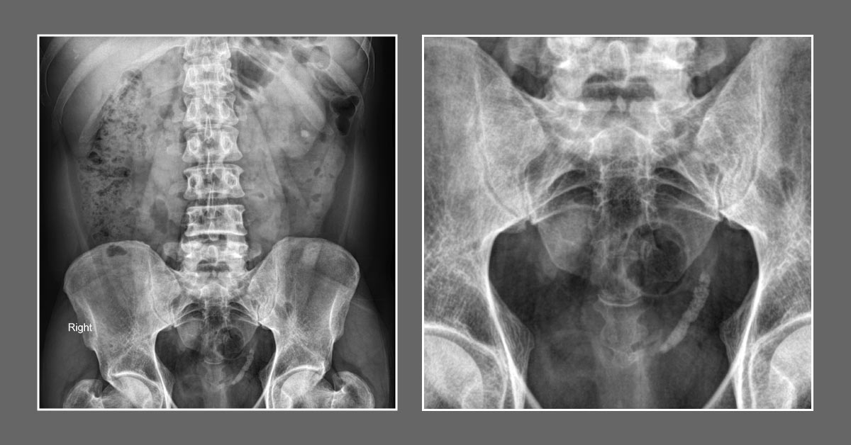 Diagnose A Patient With Severe Renal Colic