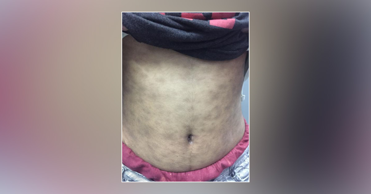 What Are These Black Areas From Three Months? 