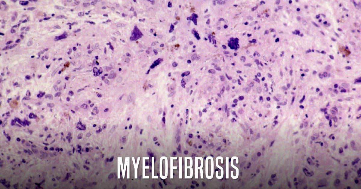 Myelofibrosis: Frequently Asked Questions