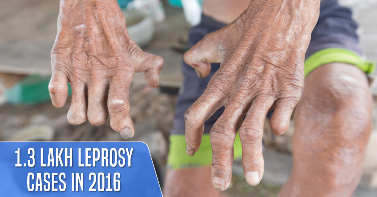Shocking: Leprosy-free India Has More Than 1.3 Lakh Reported Cases