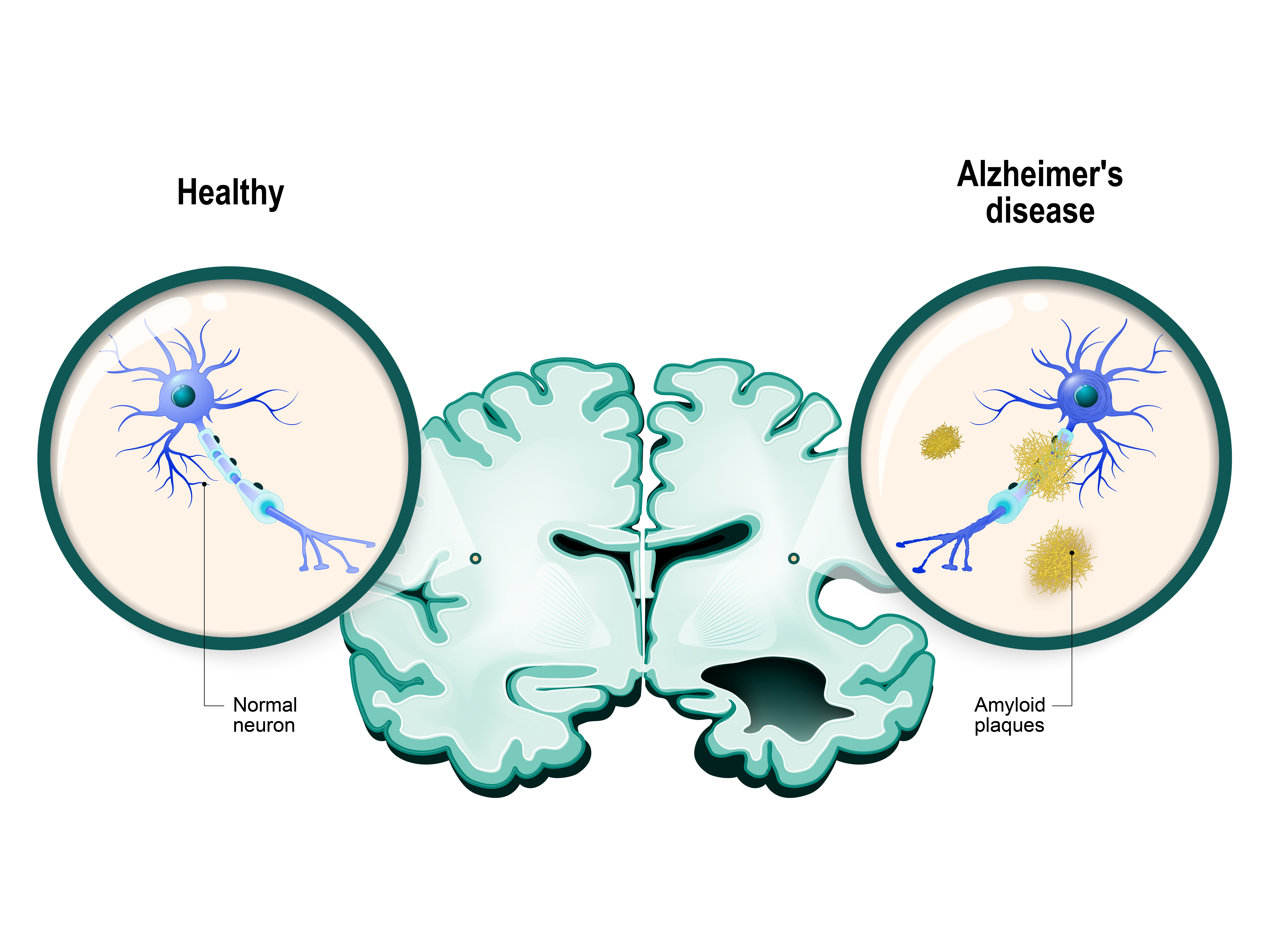 Alzheimer's Disease And Anaesthesia