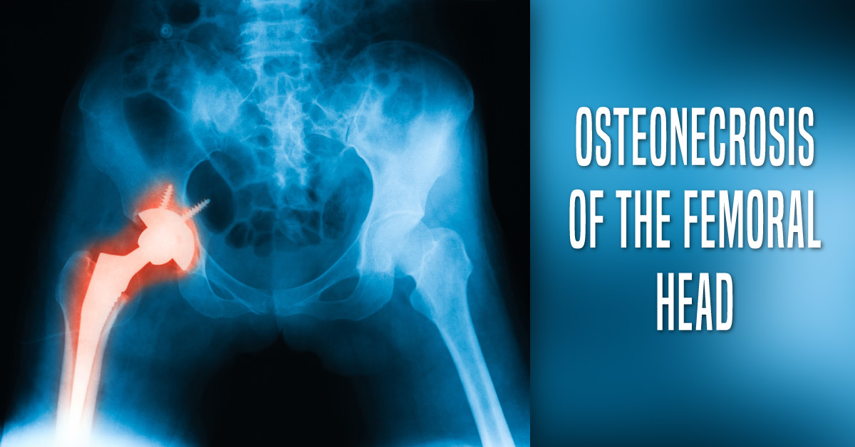 How Can ONFH Be Treated in Young Individuals?