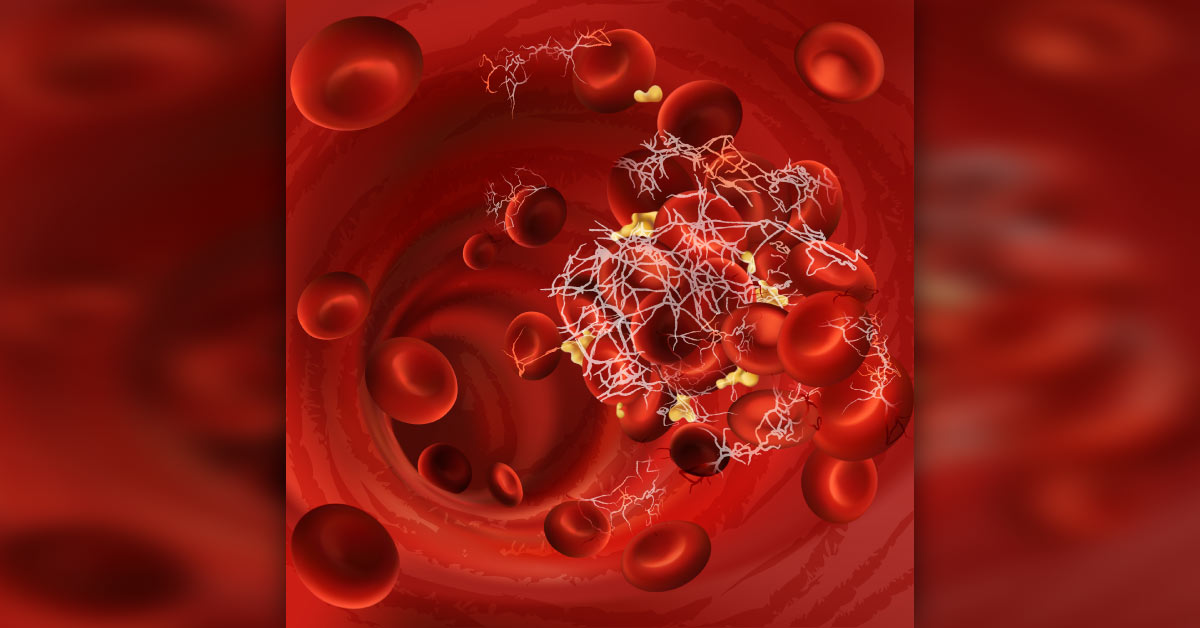 Review On Peripheral Vascular Diseases