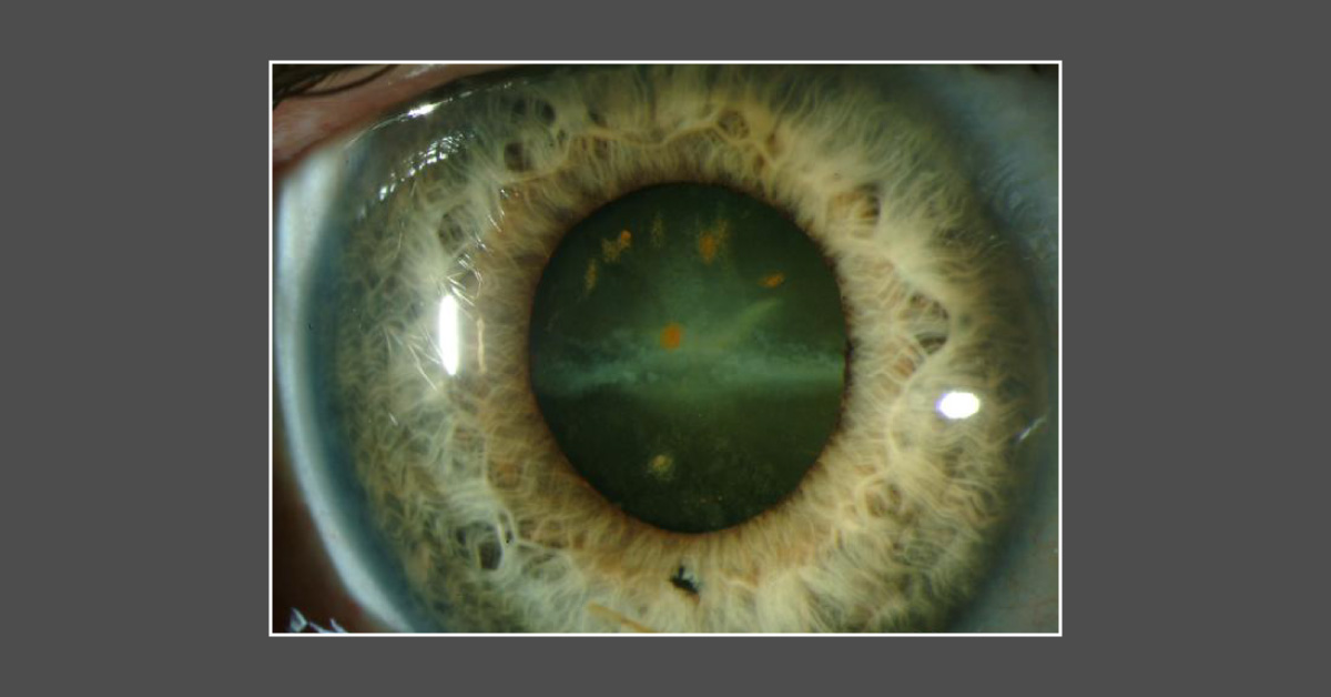 Diagnose The Image For Ophthalmic Condition