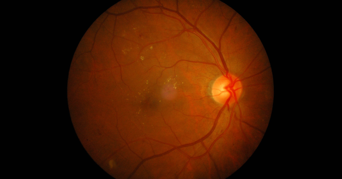 Keith Wagener And Barker Classification Of Hypertensive Retinopathy