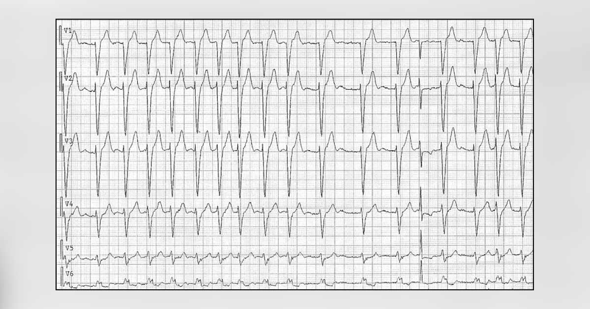 A 95-year-old Lady with Palpitations
