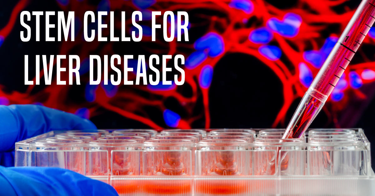 Should Use Of Stem Cells Be Popularized For Treatment Of Liver Diseases?