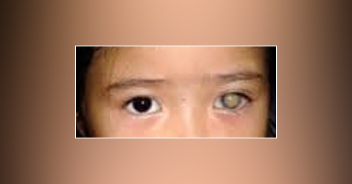 Brief Review On Causes Of Leukocoria