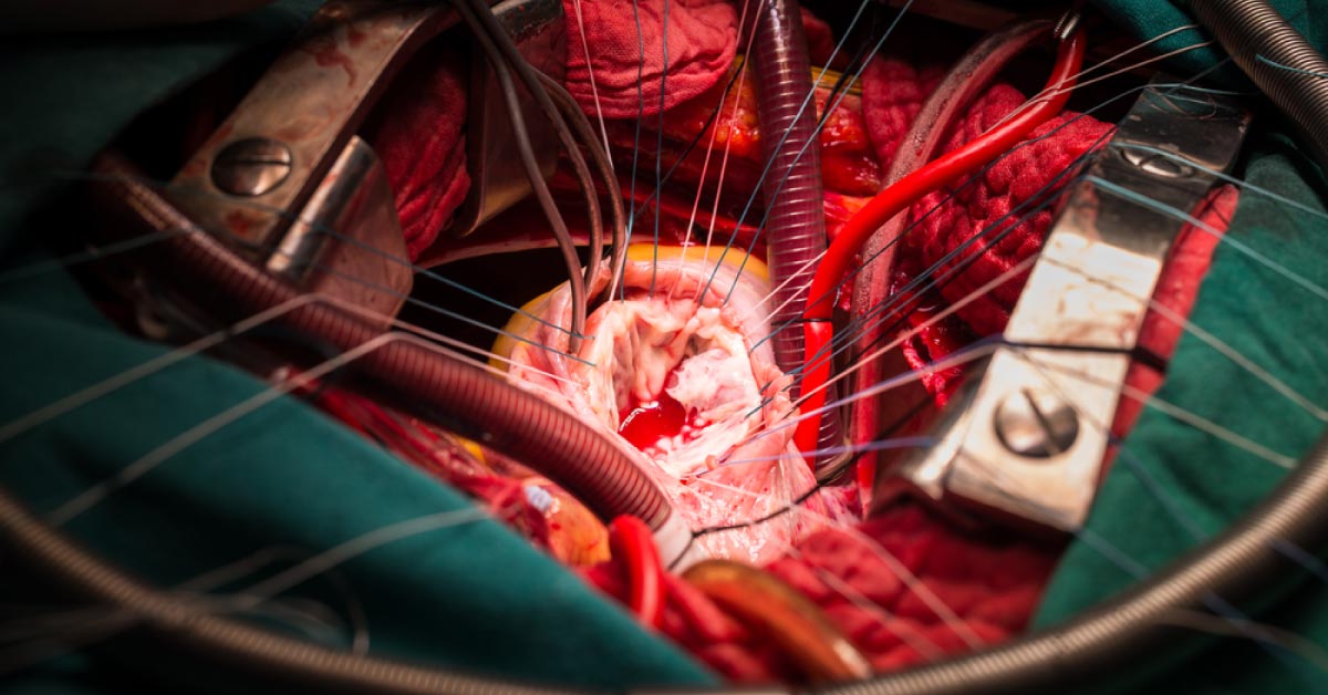 Asia’s First Percutaneous Tricuspid Valve Replacement
