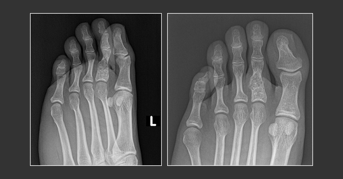 Spot the Abnormality in the X-ray Images of This Woman's Foot