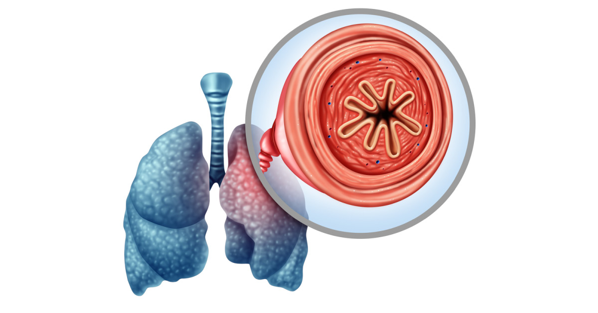 FDA Allows Revefenacin An Once Daily Dose Medicine In Treatment Of COPD