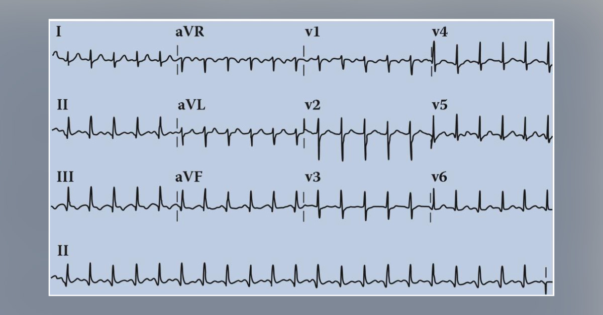 Manage This Patient with Cardiac Complication
