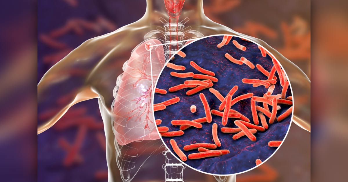 Social Stigma  Plays A Large Role In The Health Outcomes Of Patients Especially Those Living With TB