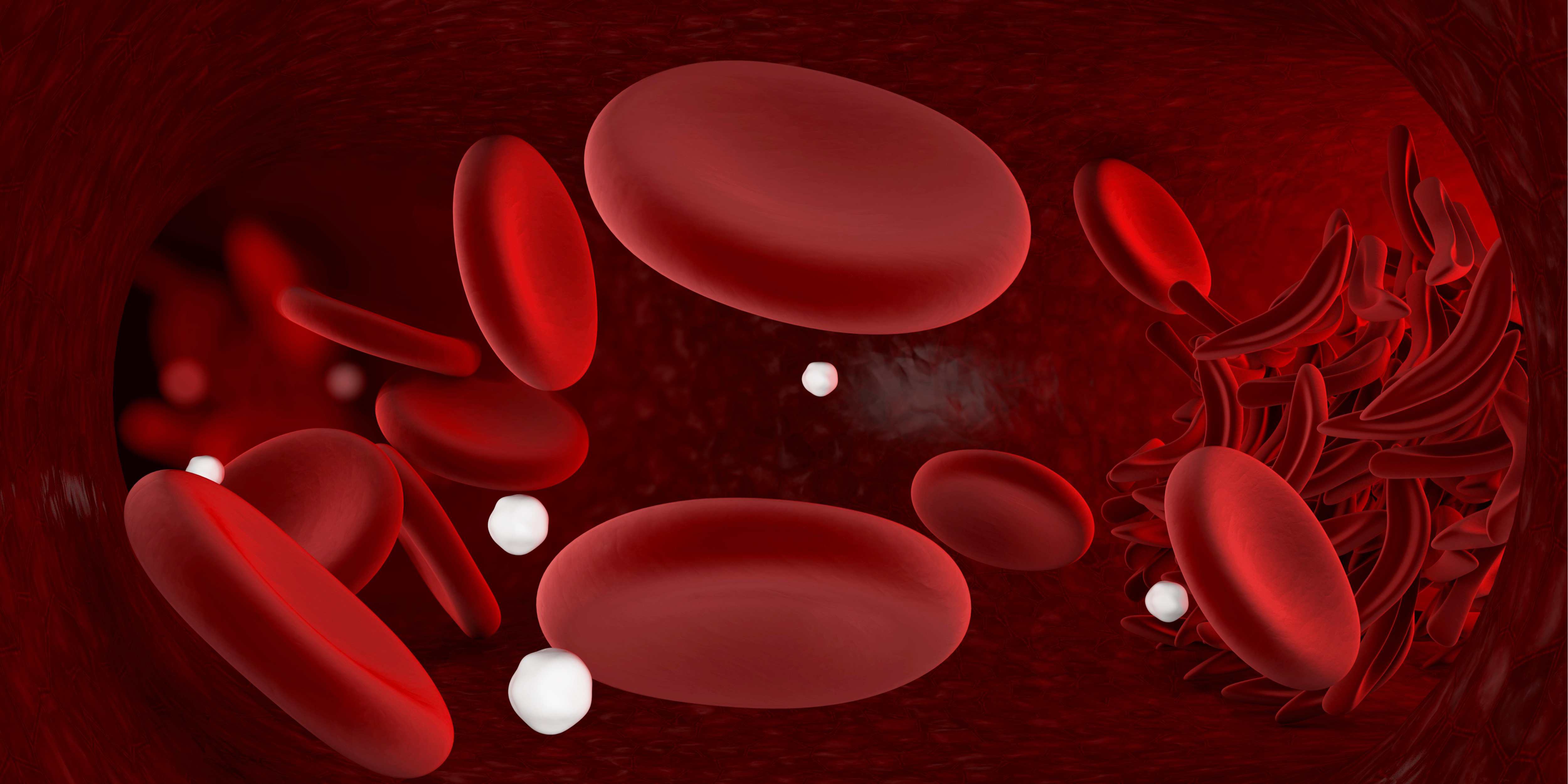Sickle Cell Anemia: Frequently Asked Questions