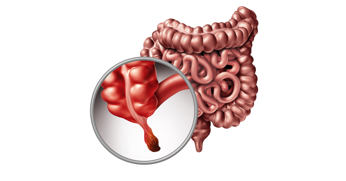 Antibiotic Therapy vs Appendectomy For Treatment Of Uncomplicated Acute Appendicitis