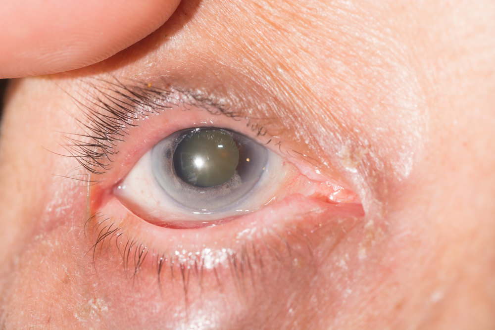 Causes Of Iris Atrophy