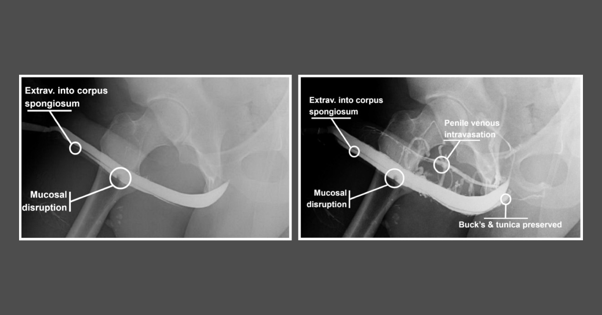 Pain Following Sexual Intercourse: What is Your Diagnosis?