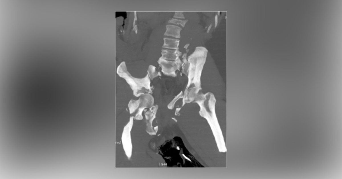 Accident Victim with a Blunt Trauma