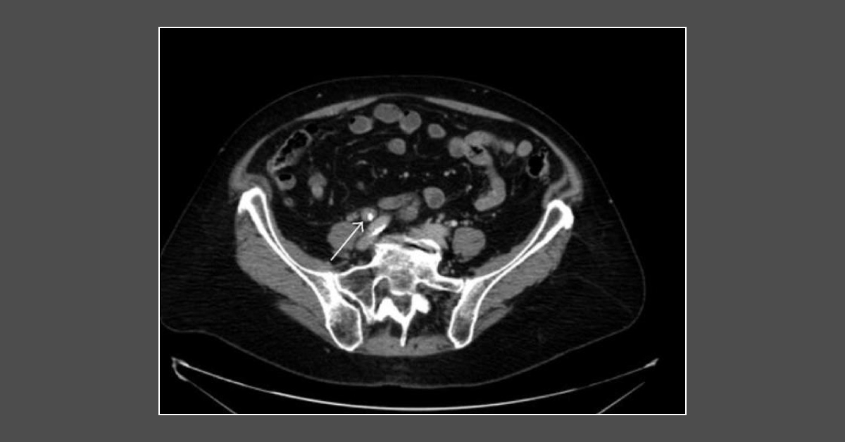 Case of Anorexia, Weight Loss, and Asthenia