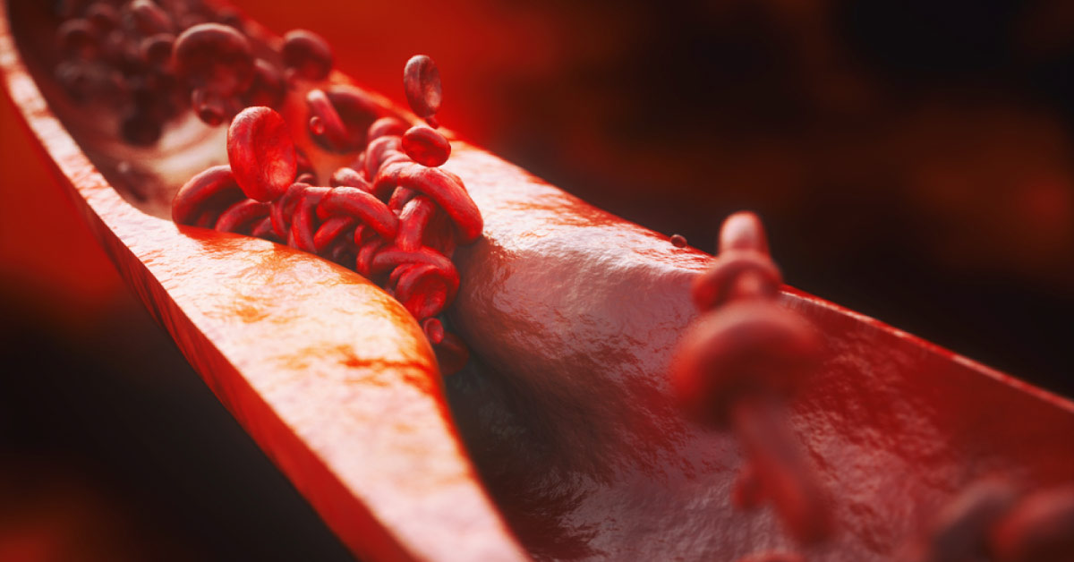 The 'Obesity Paradox' In Silent Coronary Artery Disease And Diabetes