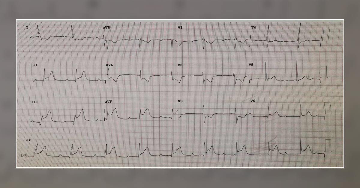 56-Year-Old With Chest Pain