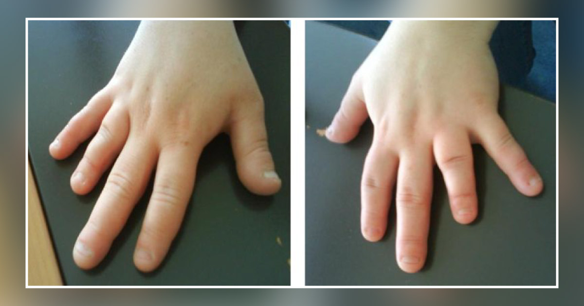 Solve The Bariatric Surgery Case?