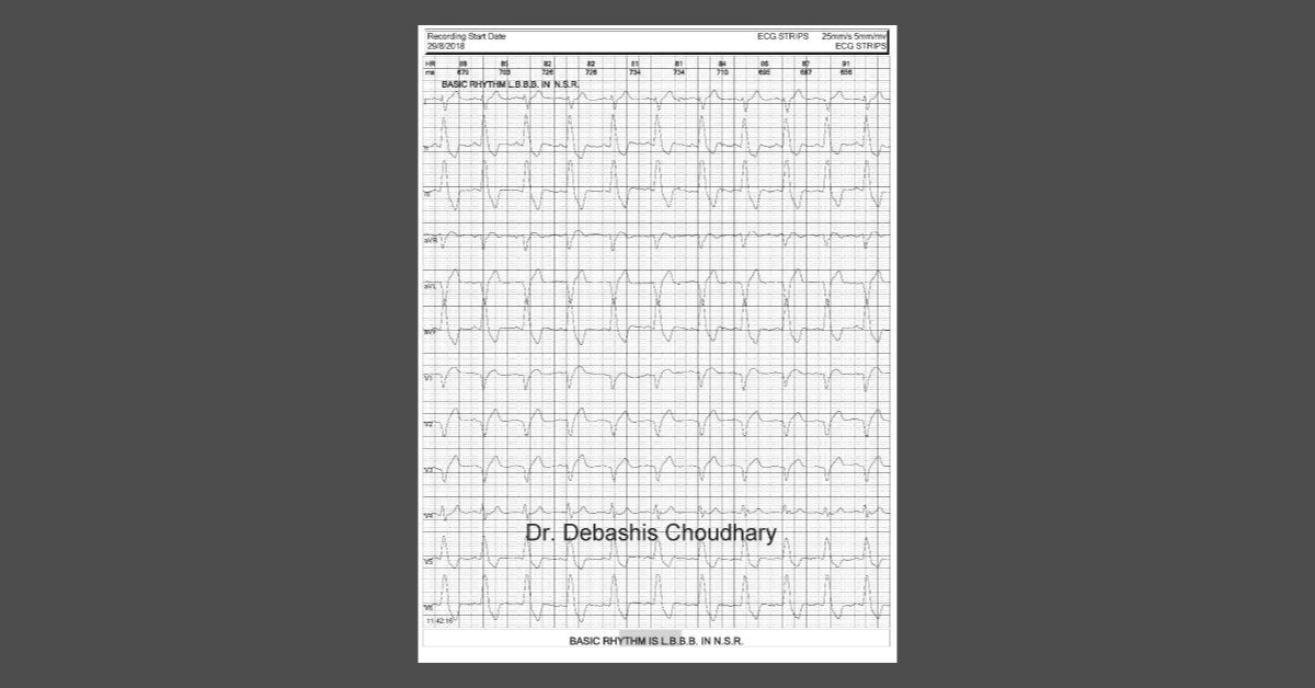 Variable Conduction Disorder