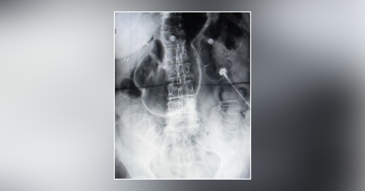 A Case of Sudden Abdominal Pain