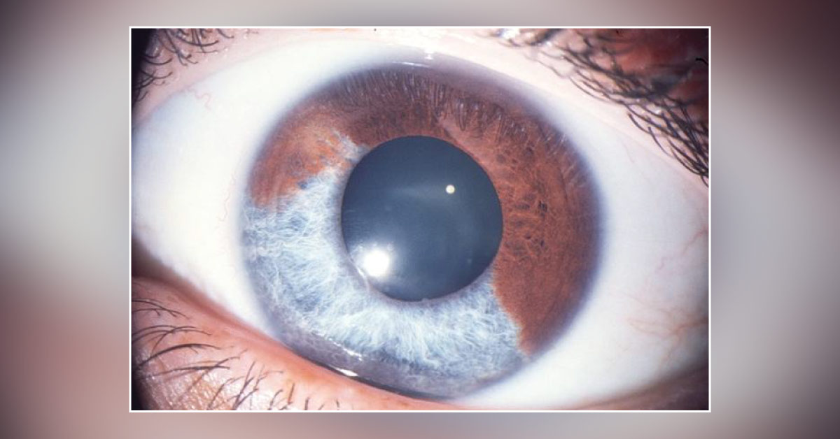 Causes Of Iris Atrophy