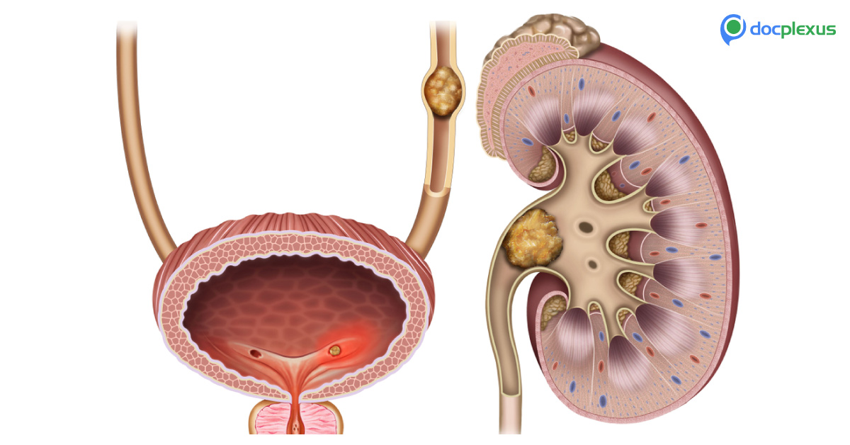 A Case of Moderate-Sized Distal Ureteral Calculi