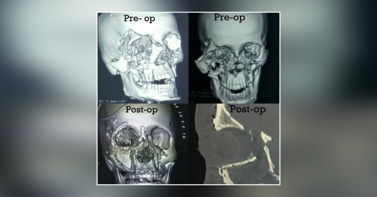 Orbital Fracture Management: The Unclaimed Domain Of Oculoplasty