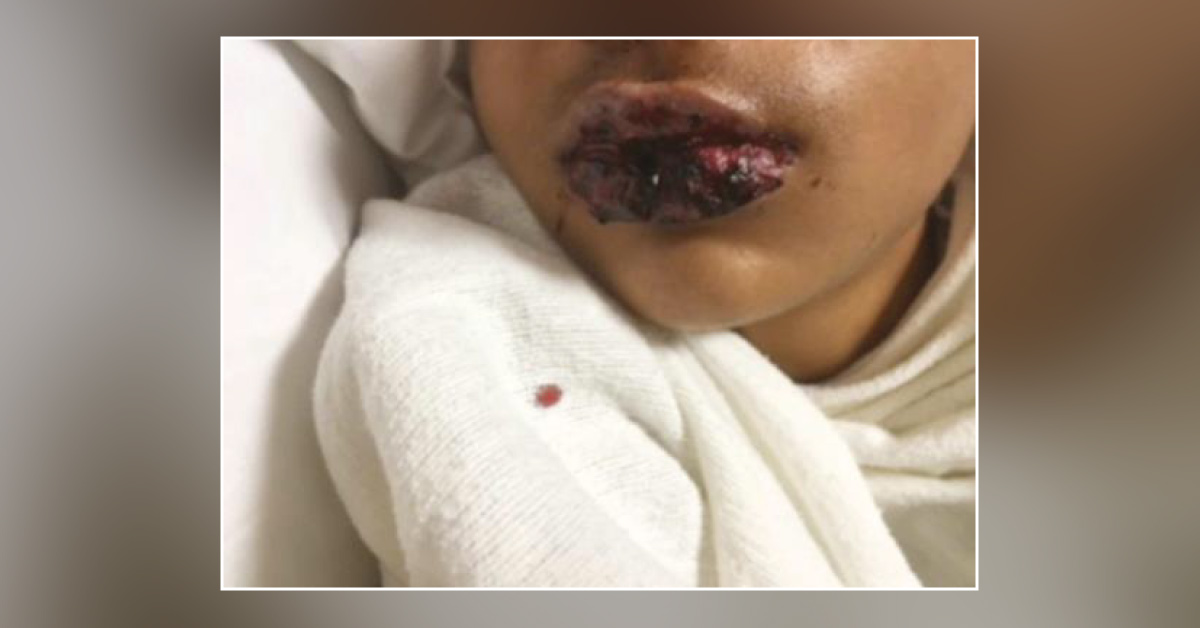 Ulceration of Lips: Can You Diagnose This Boy?