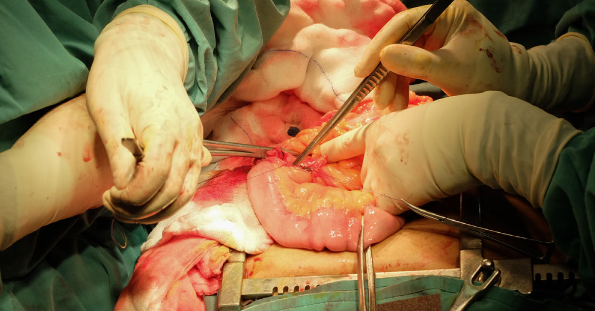 Avoiding Recurrence Of Colon Cancer, Is Surgery Sufficient