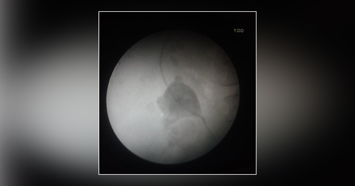 Case Of A Big Kidney Stone